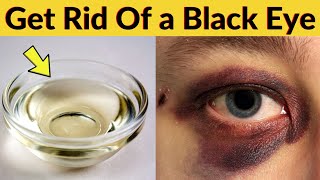 How To Get Rid Of a Black Eye Overnight Quickly and Faster – Natural Home Remedy [upl. by Akim618]