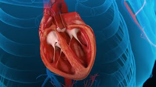 Cardiomyopathy Heart animation [upl. by Nonahs360]