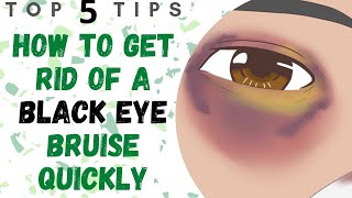 How To Get Rid Of A Black Eye Bruise Quickly  Black Eye Cover Up [upl. by Entsirhc775]