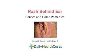 Rash behind Ear 10 Possible Causes and Home Remedies [upl. by Damha]