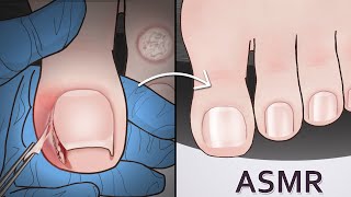 ASMR｜Ingrown Toenail and Corn removal treatment animation  凍甲甲溝炎＆雞眼治療動畫｜내성발톱amp티눈 치료｜魚の目の芯を取る 巻き爪治療 [upl. by Nylarad]