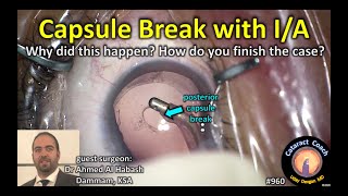 posterior capsule break during IA in cataract surgery [upl. by Abrams]