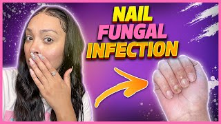 How I got a nail fungal infectionand treated it [upl. by Domenech592]