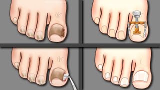 ASMR Ingrown Toenail Removal Treatment Animation [upl. by Gildus620]