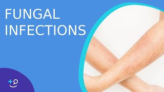 Fungal Infections  Causes Prevention and Cure [upl. by Eatnohs]