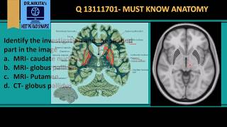 MRI Brain anatomy  Basal ganglia [upl. by Meridith]