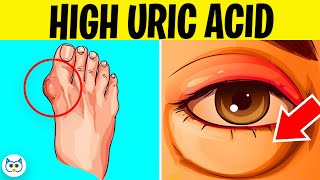 7 Symptoms of High Uric Acid Levels In The Body  Gout Symptoms [upl. by Wilona863]