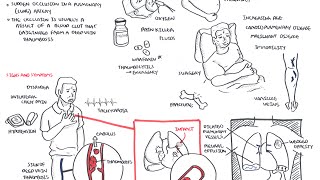 Pulmonary Embolism  Overview [upl. by Fu]