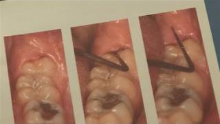 How To Alleviate Infected Wisdom Tooth [upl. by Nyrmac]