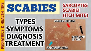 Scabies Classic Crusted Nodular Scabies Symptoms Diagnosis and Treatment  Itch Mite [upl. by Eentrok397]