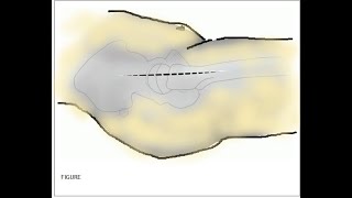 Hardinge Approach  Lateral Approach to the Hip [upl. by Aneela]