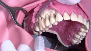 Periodontal surgery Modified Widmann flap [upl. by Alarise]