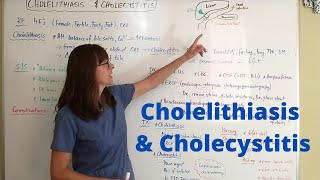 Cholelithiasis amp Cholecystitis [upl. by Airehc]