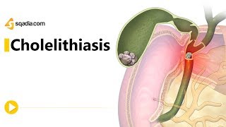 Gallstones and Cholecystitis  Signs Symptoms And Treatment [upl. by Arch]