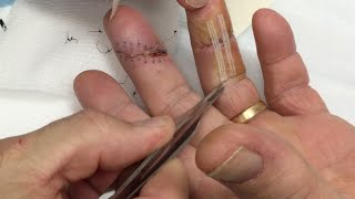 Hand Lac Suture Removal by Dr Gonzo More Houston Rain [upl. by Serilda]