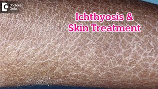 What is Ichthyosis How to Treat my Skin Fish like scales On SkinDrRasya Dixit  Doctors Circle [upl. by Ellecram]